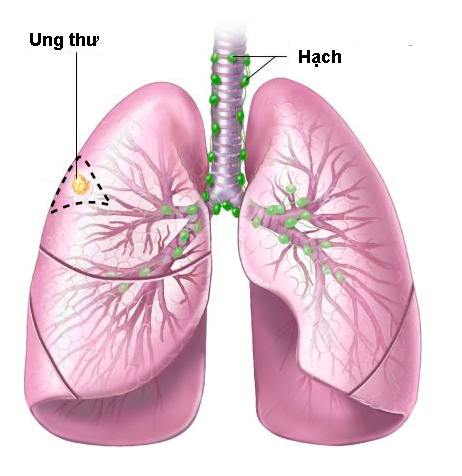 Đông Trùng Hạ Thảo chữa bệnh ung thư phổi